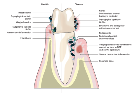 perimplantite-microbiota-orale-gengiviti