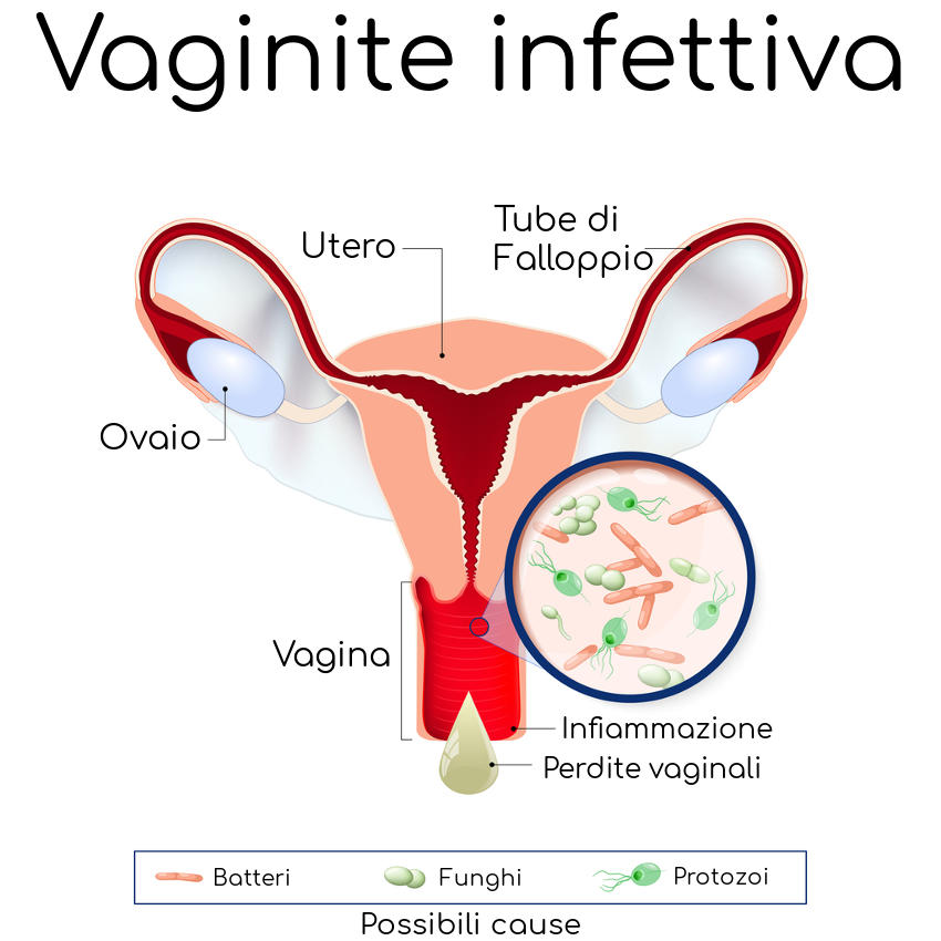 Vaginite batterica infiammazione e cause sono spesso correlate alla presenza di batteri, funghi e altri agenti patogeni
