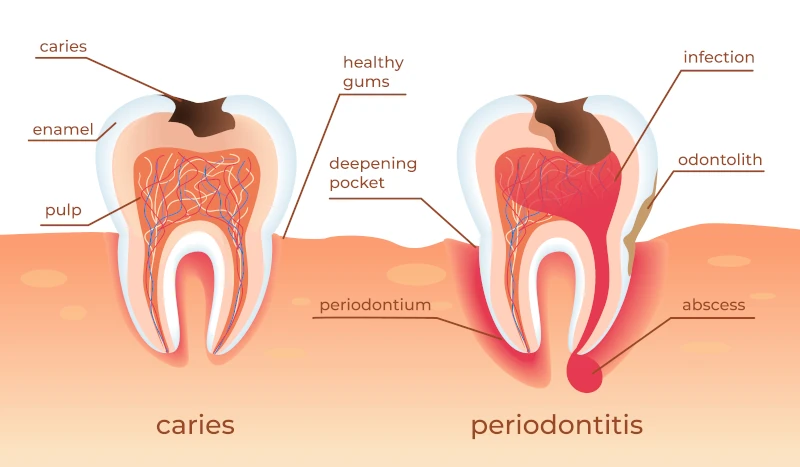 peridontite-carie